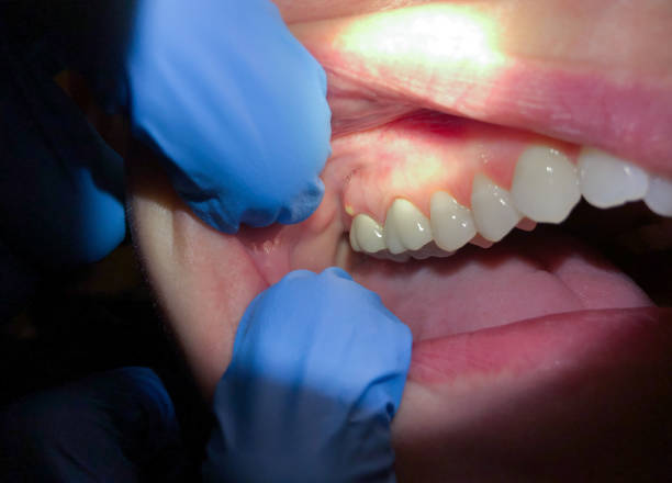 Best Emergency Dental Care for Sports Injuries in Rolling Meadows, IL